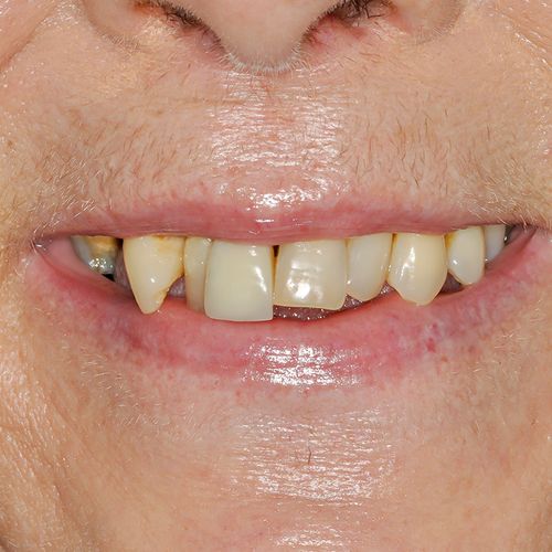 Before - Smile in a day - Dara Fahy - 3dental